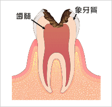より大きくなった虫歯（C3）