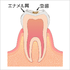 小さな虫歯（C1）